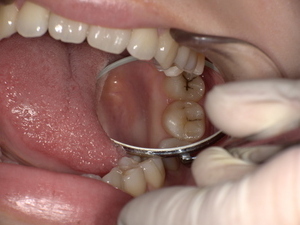 上の親知らず 虫歯のある上の親知らず