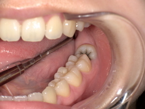 Before( 横に生えた状態で埋まっている親知らず 虫歯がある親知らず)