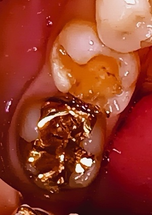 治療前 金属のインレーが外れている