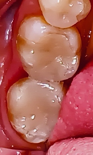 セラミックインレー装着後