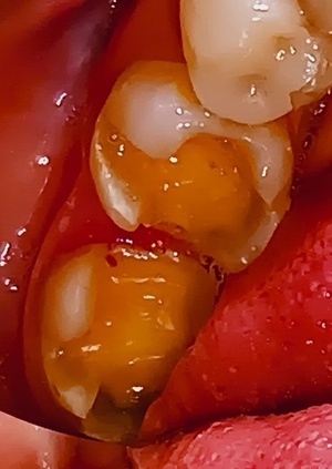 治療中 金属インレーを外したところ