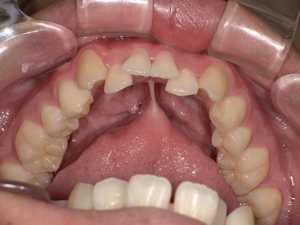 Before 舌小帯が短い