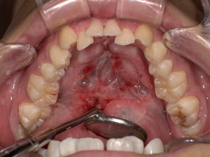 After  舌小帯切除後