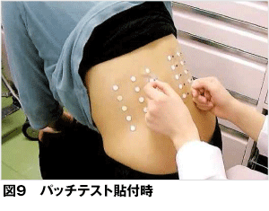 金属アレルギーの検査のパッチテスト