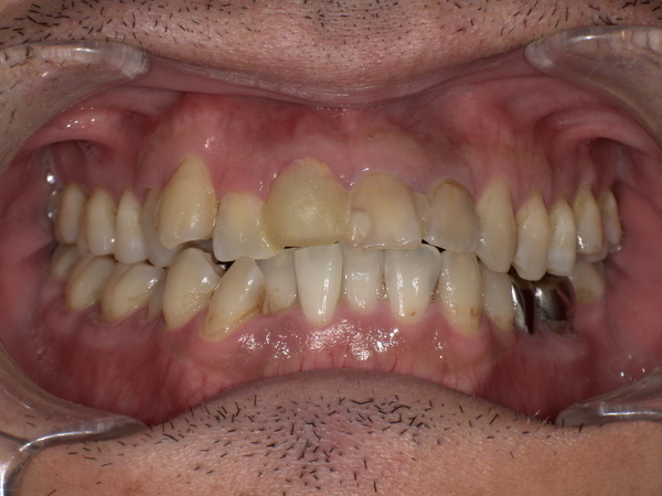 Before(色と形のよくない被せが装着されている)