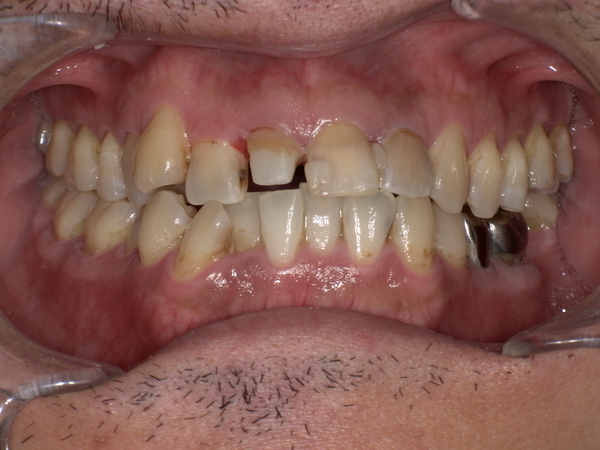 治療中(土台であるファイバーコアを装着したところ)