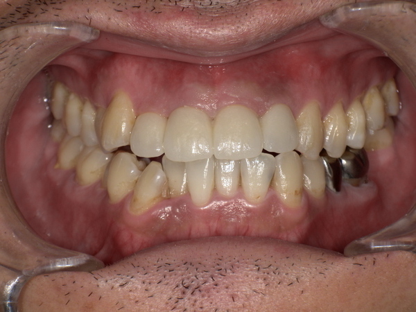 After(ジルコニアセラミック装着後)