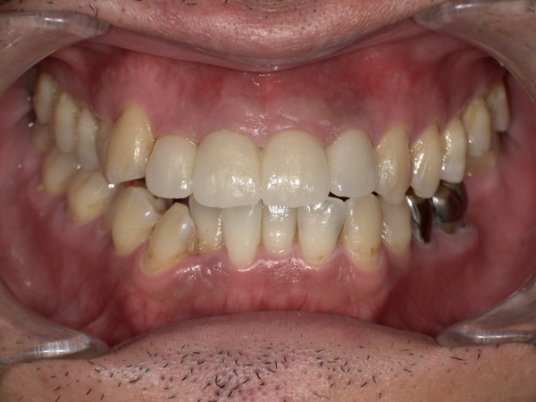 After(ジルコニアセラミック装着後)