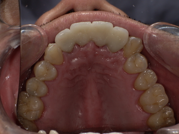 After(ジルコニアセラミック装着後)