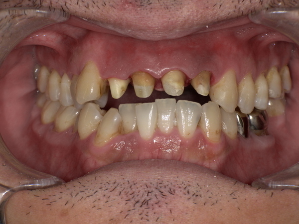 治療中(削って型を取る前)