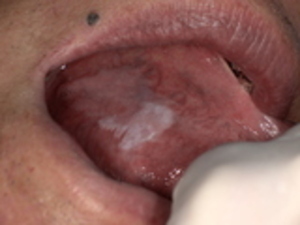 舌の側縁に現れた白板症(白いしこり)の症例|名古屋市天白区イナグマ歯科_コピー