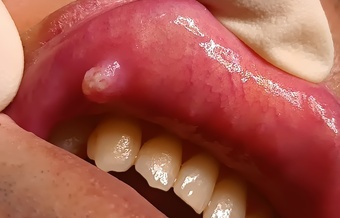 口の中のできもの