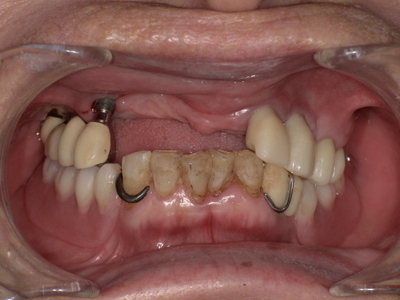 Before ノンクラスプデンチャー装着前_コピー