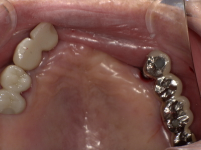 Before ノンクラスプデンチャー装着前