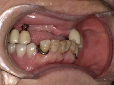 Before ノンクラスプデンチャー装着前_コピー