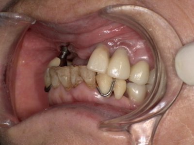 Before ノンクラスプデンチャー装着前_コピー