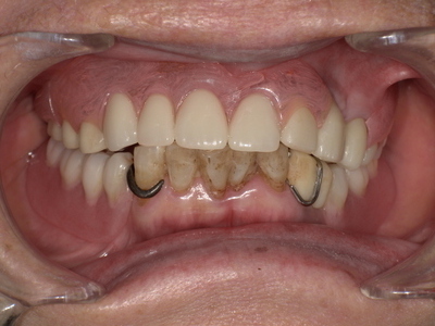 After ノンクラスプデンチャー装着後