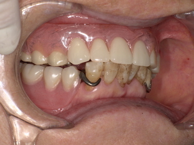 After ノンクラスプデンチャー装着後