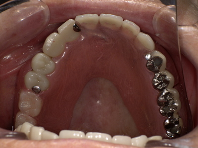 After ノンクラスプデンチャー装着後