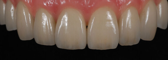 ジルコニアセラミック治療