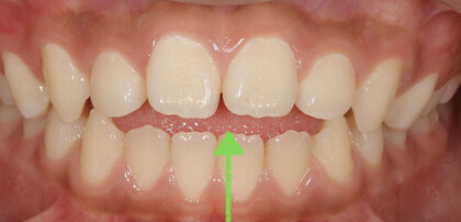 小児の-開咬-治療_コピー_コピー