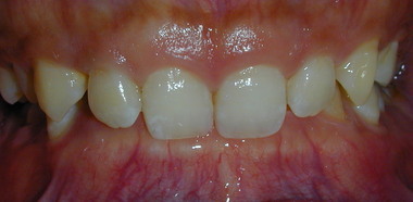 過がい咬合_コピー_コピー