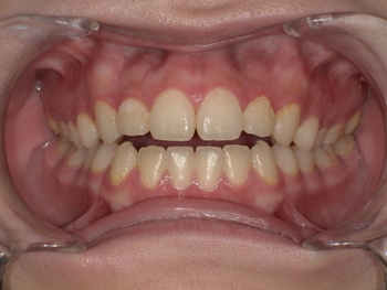 Before(歯ぎしり防止装置装着前)