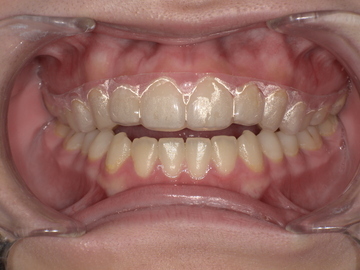 Aftre(歯ぎしり防止装置装着後)