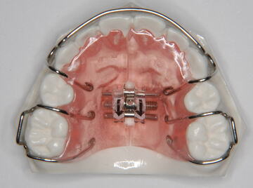 拡大装置 小児矯正