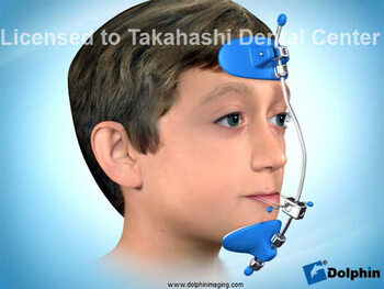 ファイスマスク 小児矯正治療