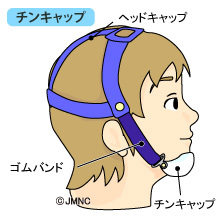 チンキャップ　　小児矯正治療