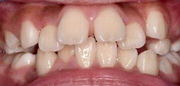 上顎前突・叢生 子供