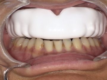 スポーツマウスガード装着後