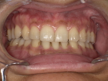 スポーツマウスガード装着前