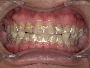 無呼吸症候群のマウスピース装着後