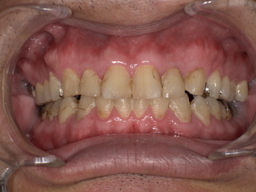 無呼吸症候群のマウスピース装着前