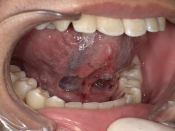 舌小帯切除後 After
