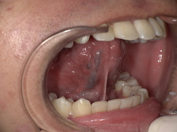 舌小帯切除前 Before