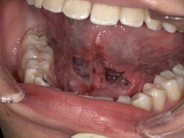 舌小帯切除後 After