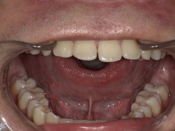 舌小帯切除前　Before