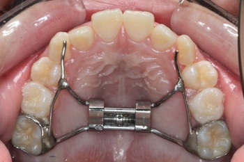 急速拡大装置_コピー