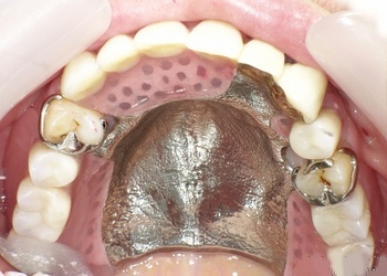 チタン床義歯2