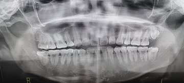 右親知らず抜歯前 Before