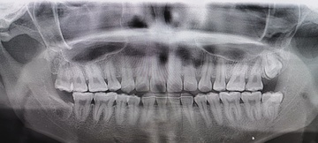 右親知らず抜歯後 After