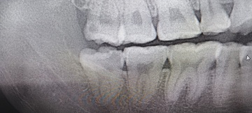 右親知らず抜歯前 Before