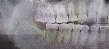 右親知らず抜歯後 After