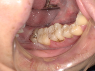 親知らず抜歯前 Before