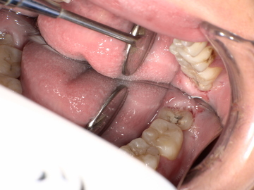 親知らず抜歯前 Before