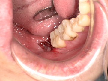 親知らず抜歯後 After