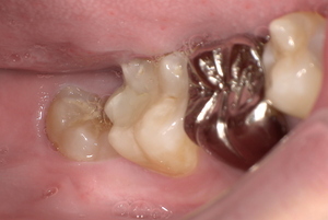 斜めに生えた親知らず　Before